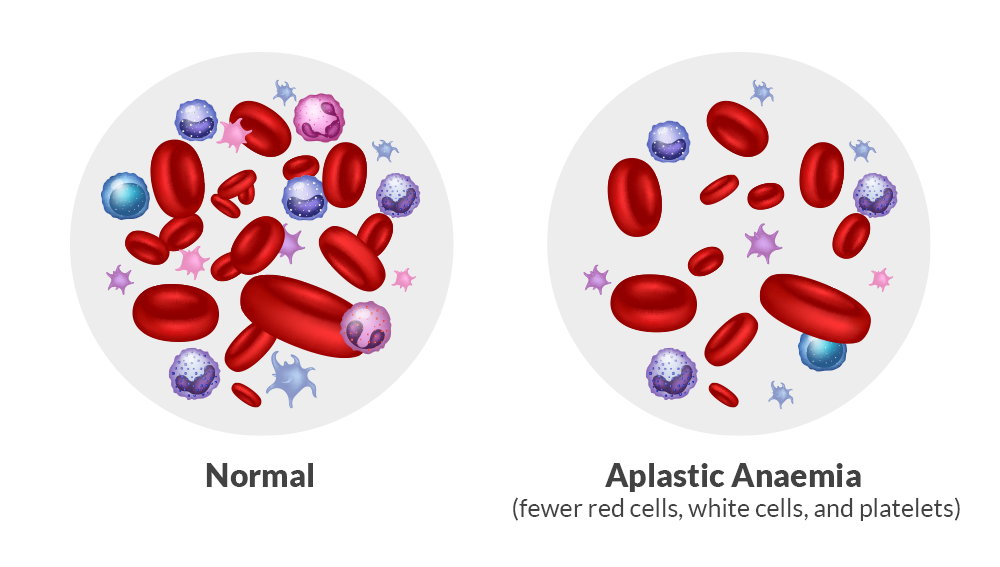 aplastic anemia symptoms, causes, risk factors treatment | dr adamya gupta, hematologist, hemato oncologist raipur
