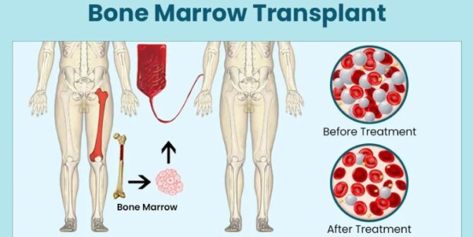 Bone marrow transplant in raipur | dr adamya gupta hematologist in raipur