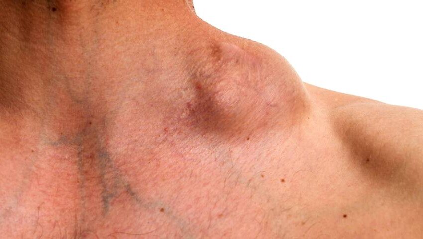 lypmphoma treatment in raipur | Dr. Adamya Gupta