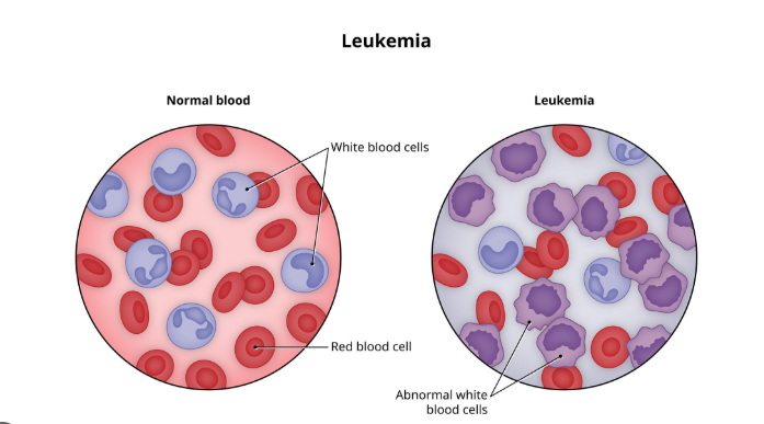 leukemia treatment raipur | dr adamya gupta hematologist