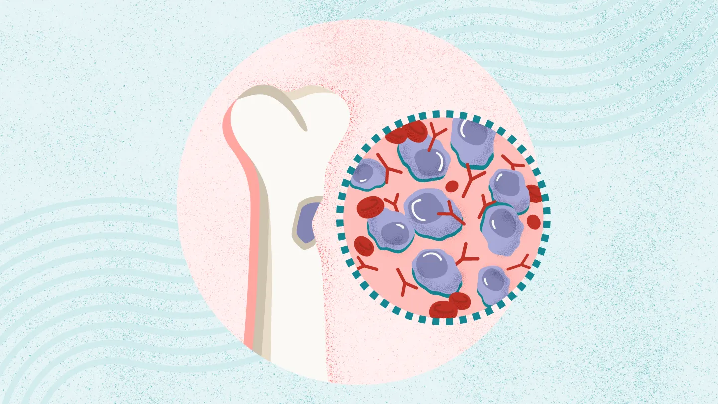 multiple myeloma symptoms causes treatment raipur | dr adamya gupta