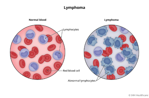 lymphoma treatment raipur