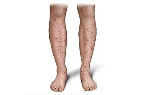 graphic illustration of purpura treatment raipur | dr adamya gupta | best hematologist raipur