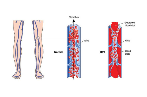 thrombotic disorders treatment raipur cg | dr adamya gupta | hematologist raipur
