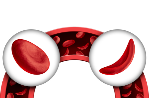 Graphic illustration of Sickle Cell Anemia Treatment in Raipur | best hemato-oncologist raipur cg | dr adamya gupta